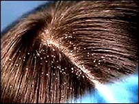 أفضل ثلاثة طرق لعلاج قشرة الشعر 12868610