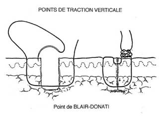 sutures chelle dessous esthtiques mauvais perroquet laissent squelles rsultats