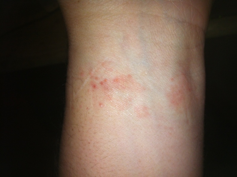 Séquence médicale : Les allergies au cuir des bracelets. Photo10