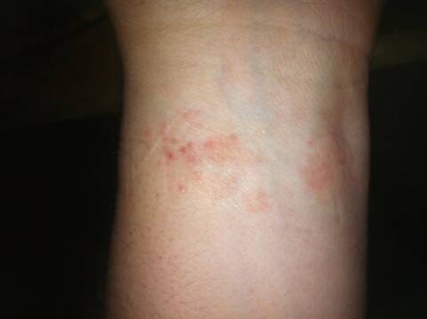 Séquence médicale : Les allergies au cuir des bracelets.