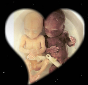mael & thiago mes 2anges partis a 20sa a cause d une chorioamniotite - Page 2 Jumeau11