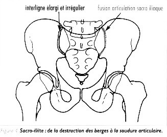 Spondylarthropathies : explications en image des principales atteintes osseuses Spa310