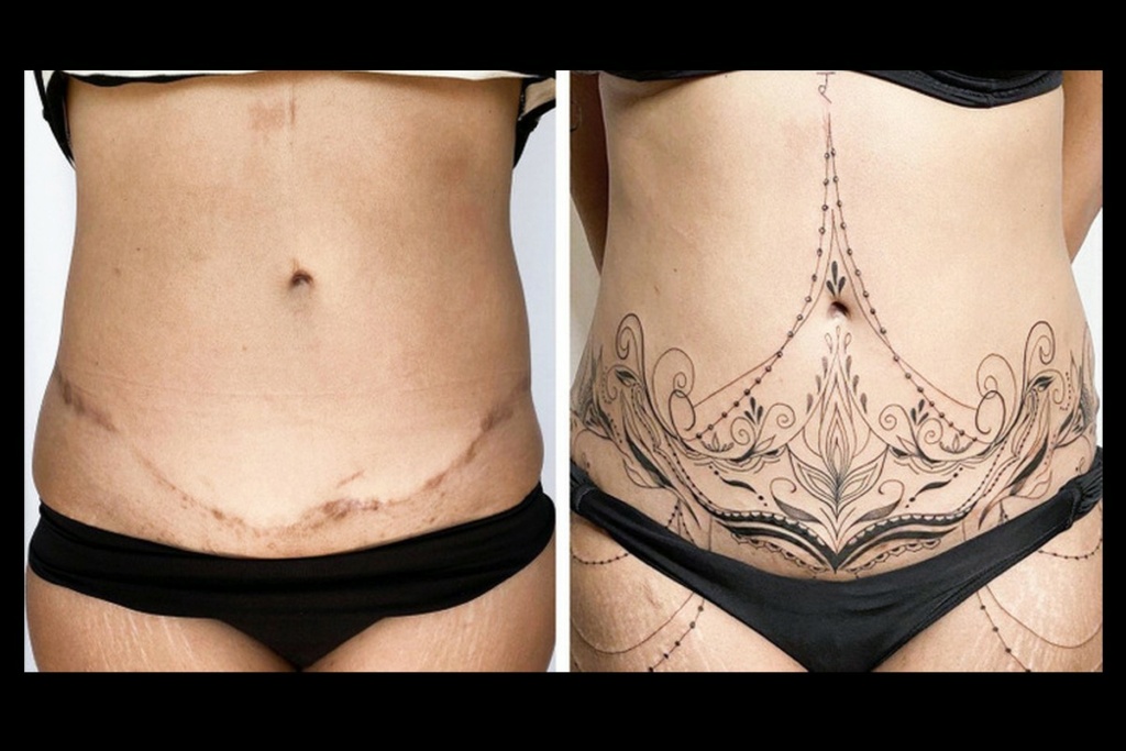Une artiste réalise des tatouages sur des cicatrices afin que les personnes puissent s’en vanter 392
