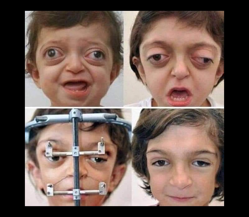 Reconstruction facial chez un enfant Sans6520
