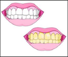 أربعة طرق للتخلص من إصفرار الأسنان Twwth10