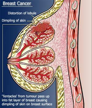 أورام الثدي الحميدة Breast12