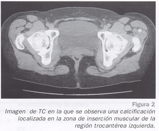 Bursitis trocantrea( PARA DUDU) Tecn_f11