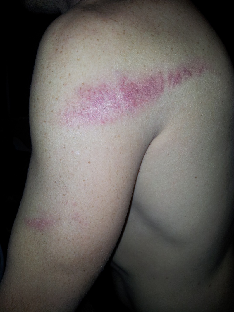 Blessures de guerre...;) Epaule10