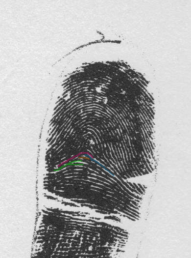 X - WALT DISNEY - One of his fingerprints shows an unusual characteristic! - Page 5 Exampl15