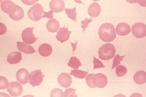 ( Microangiopathic hemolytic anemia ) 70531410