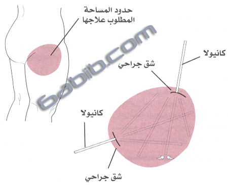 النقاهة و مضاعفات شفط الدهون 13fc0410