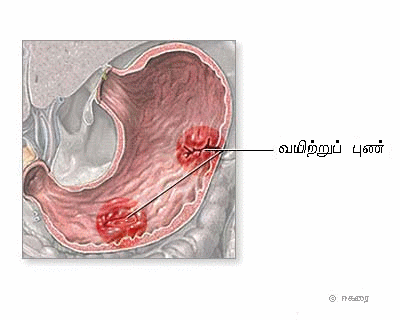 வயிற்றில் புண்கள் ஏற்படக் காரணம்? Ulcer10