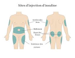 Injection sous cutanée  Images15