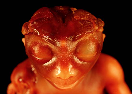 Bébé grenouille humain (Anencéphalie) Zzzr11