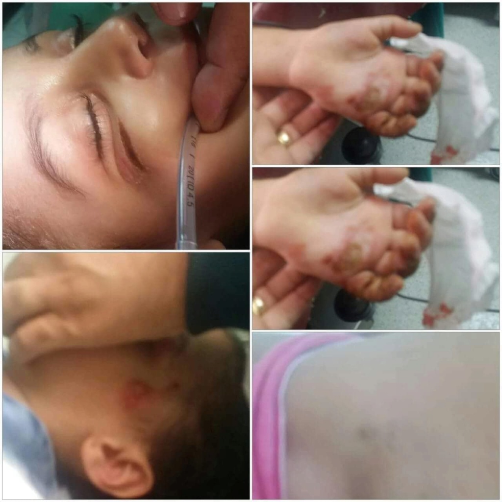 مستشفى دمياط التخصصى تستقبل طفلة تعرضت للتعزيب من زوجة ابيها  Aaao23