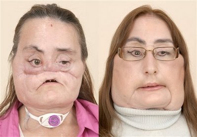 First Face Transplant! (With before and after pics) Capt_f10