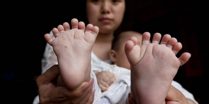 Un bébé naît avec 31 doigts et orteils en Chine La-fam10