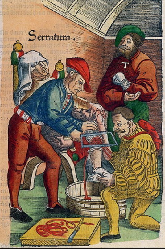 Médecine-Feldbuch der Wundarzney par Hans Von Gersdorff 1517 Feld10