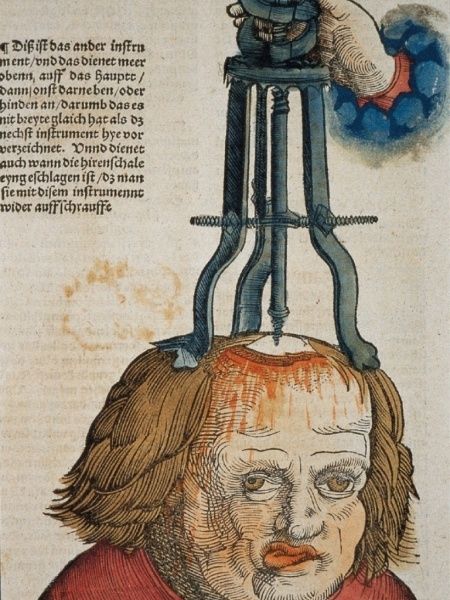 Médecine-Feldbuch der Wundarzney par Hans Von Gersdorff 1517 Feld210