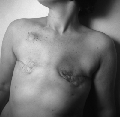 خمسة أعراض تعرف منها المرأة سرطان الثدي 210