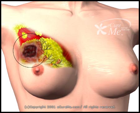 خمسة أعراض تعرف منها المرأة سرطان الثدي Breast10