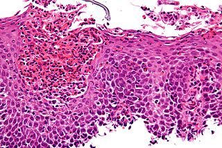 Clozapine Induced Eosinophilia: Neglected Important Adverse Effect Eosino11