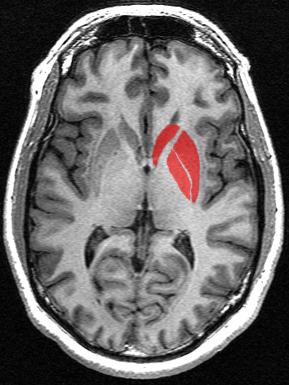 Le striatum, intervenant dans le contrôle des mouvements, est particulièrement touché