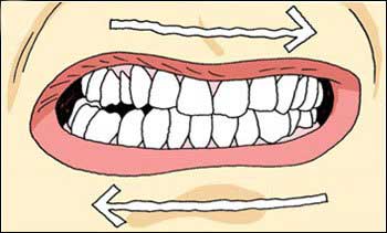 Nghiên cứu về Nghiến răng khi ngủ (Bruxism)  Teeth-10