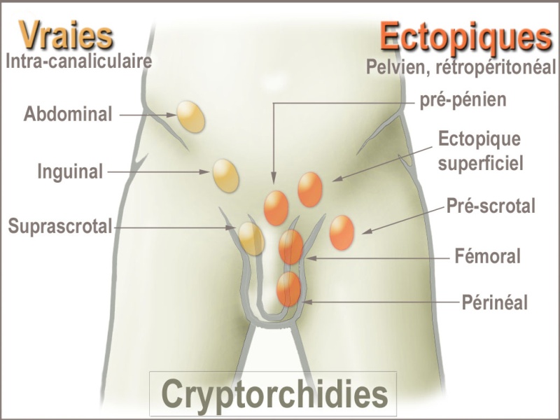 Ectopie testiculaire Crypto11