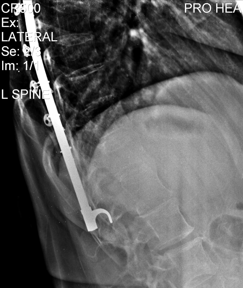 X-Rays of my kyphoscoliosis !NOT FOR THE SQUEAMISH! Copy_o11