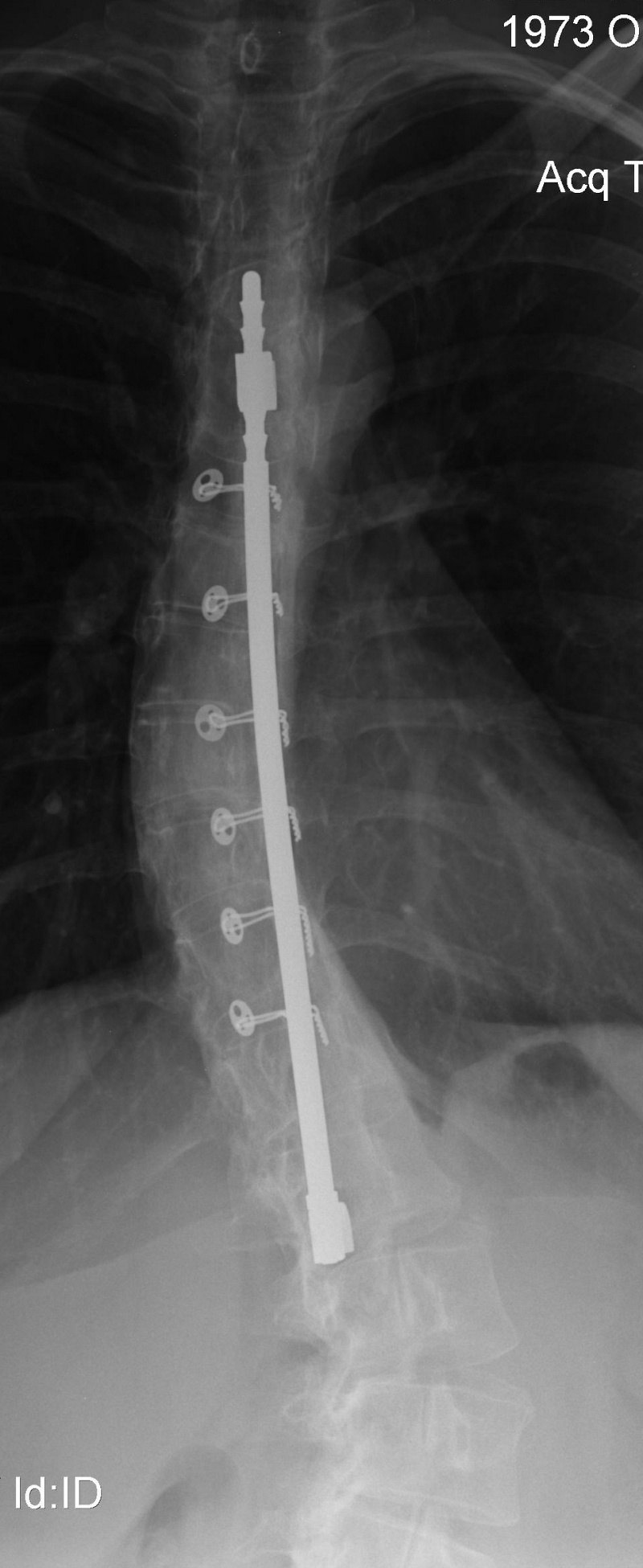 X-Rays of my kyphoscoliosis !NOT FOR THE SQUEAMISH! Copy_o12