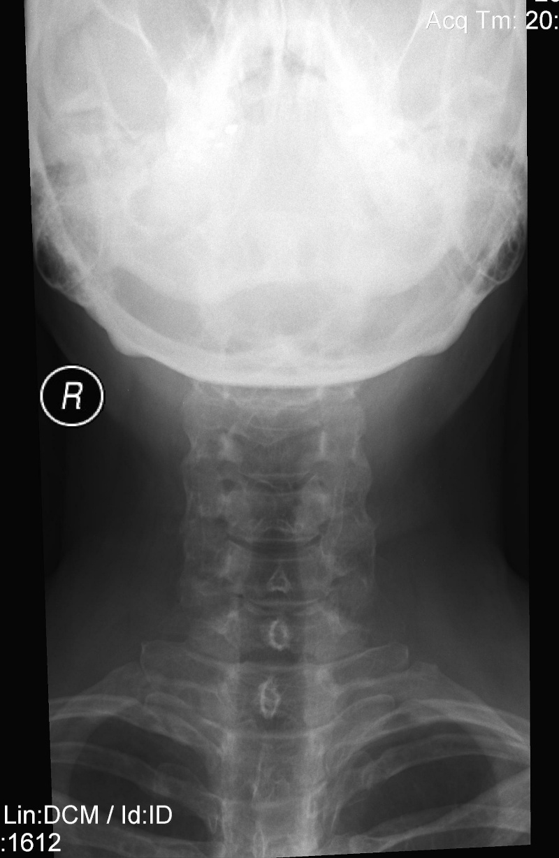 X-Rays of my kyphoscoliosis !NOT FOR THE SQUEAMISH! Copy_o14