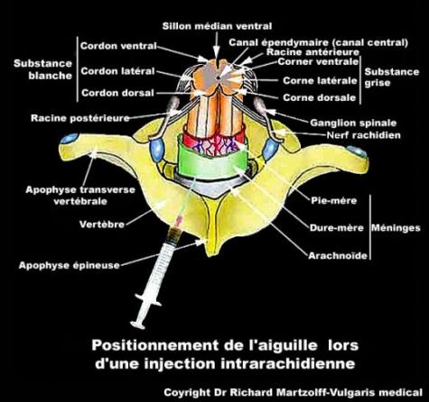 injection intrarachidienne Inject13
