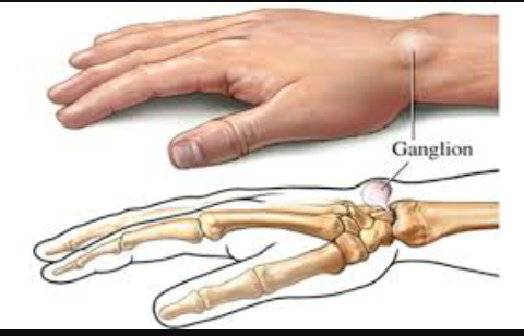 Les ganglions  Screen46