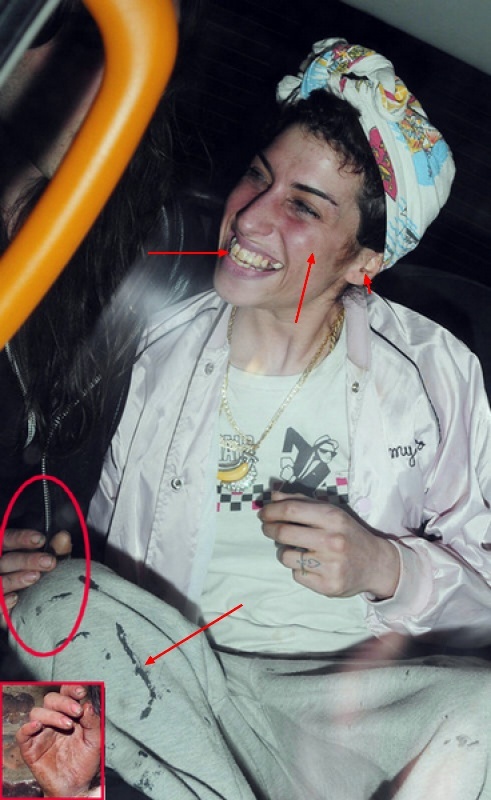 Amy Winehouse s'est fait refaire les dents 25642910