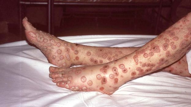 How smallpox claimed it's final victim.  _1029211