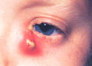 أمراض العين  O_oauo11