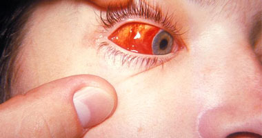 أمراض العين  O_oauo12
