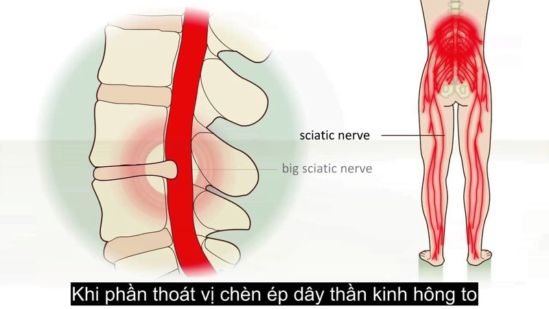 Các loại thuốc chữa đau dây thần kinh tọa Dau-da10