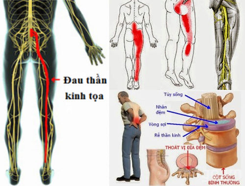 Đau dây thần kinh tọa triệu chứng Dau_th10